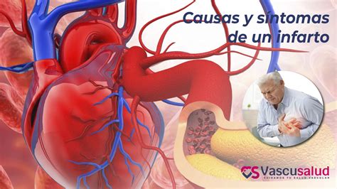 culazo de infarto|Infarto: Causas, síntomas, tratamiento y prevención .